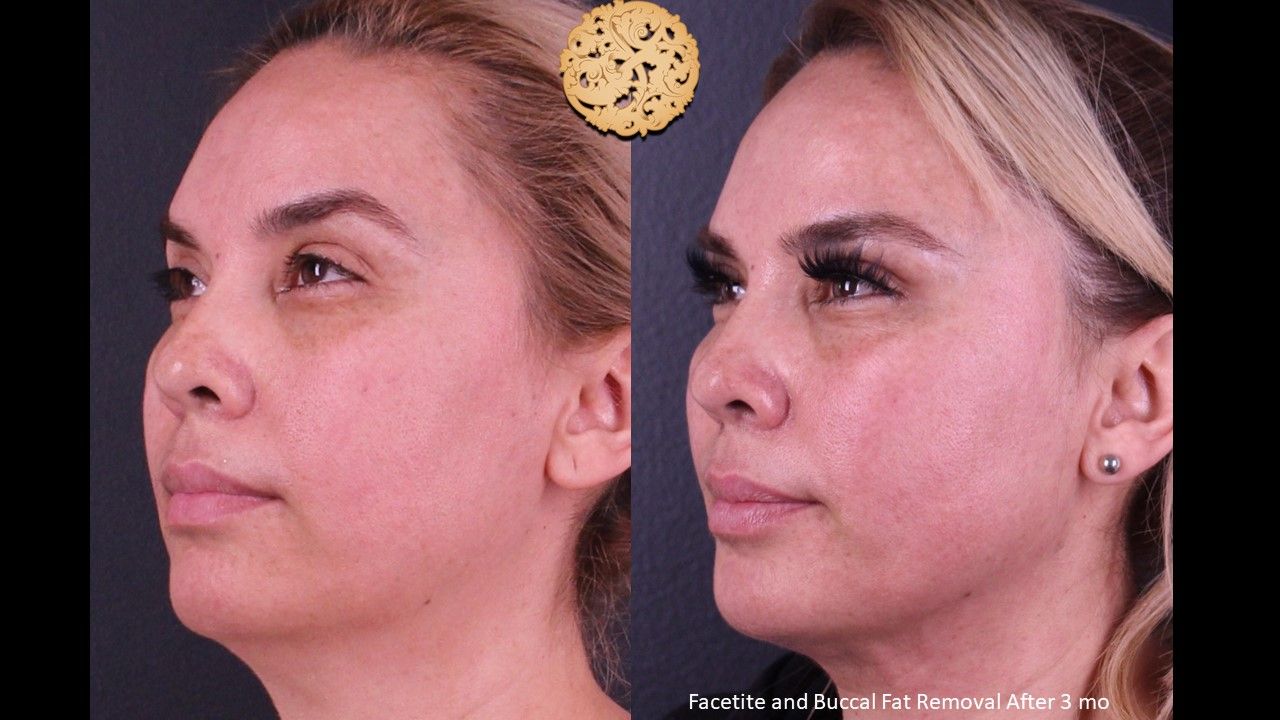 Facetite Before & After