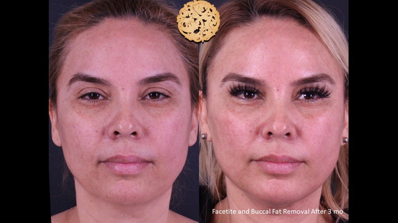 Facetite Before & After