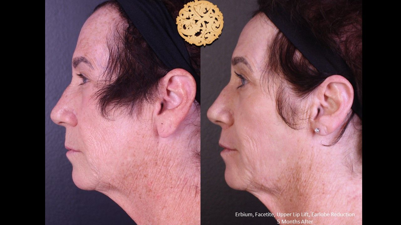 Facetite Before & After