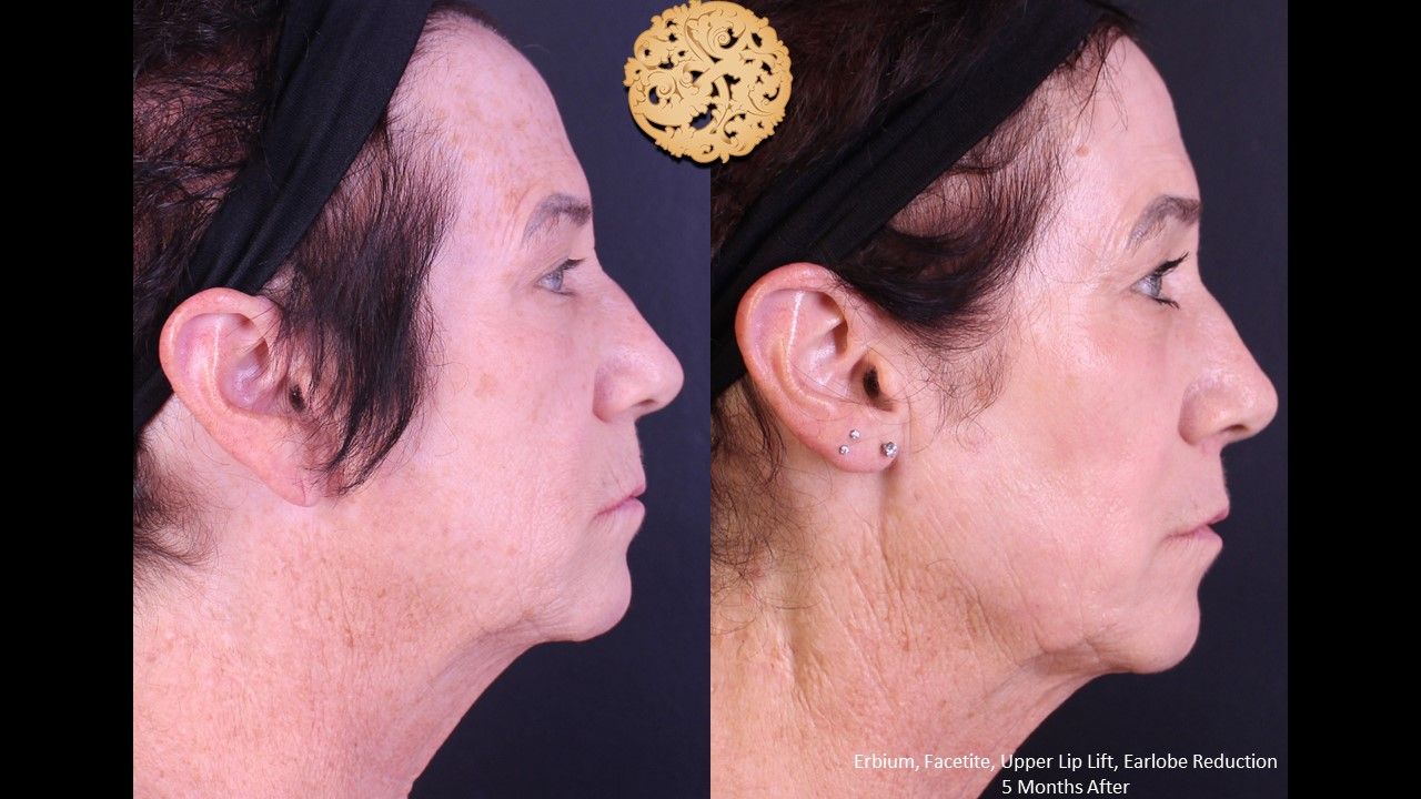 Facetite Before & After