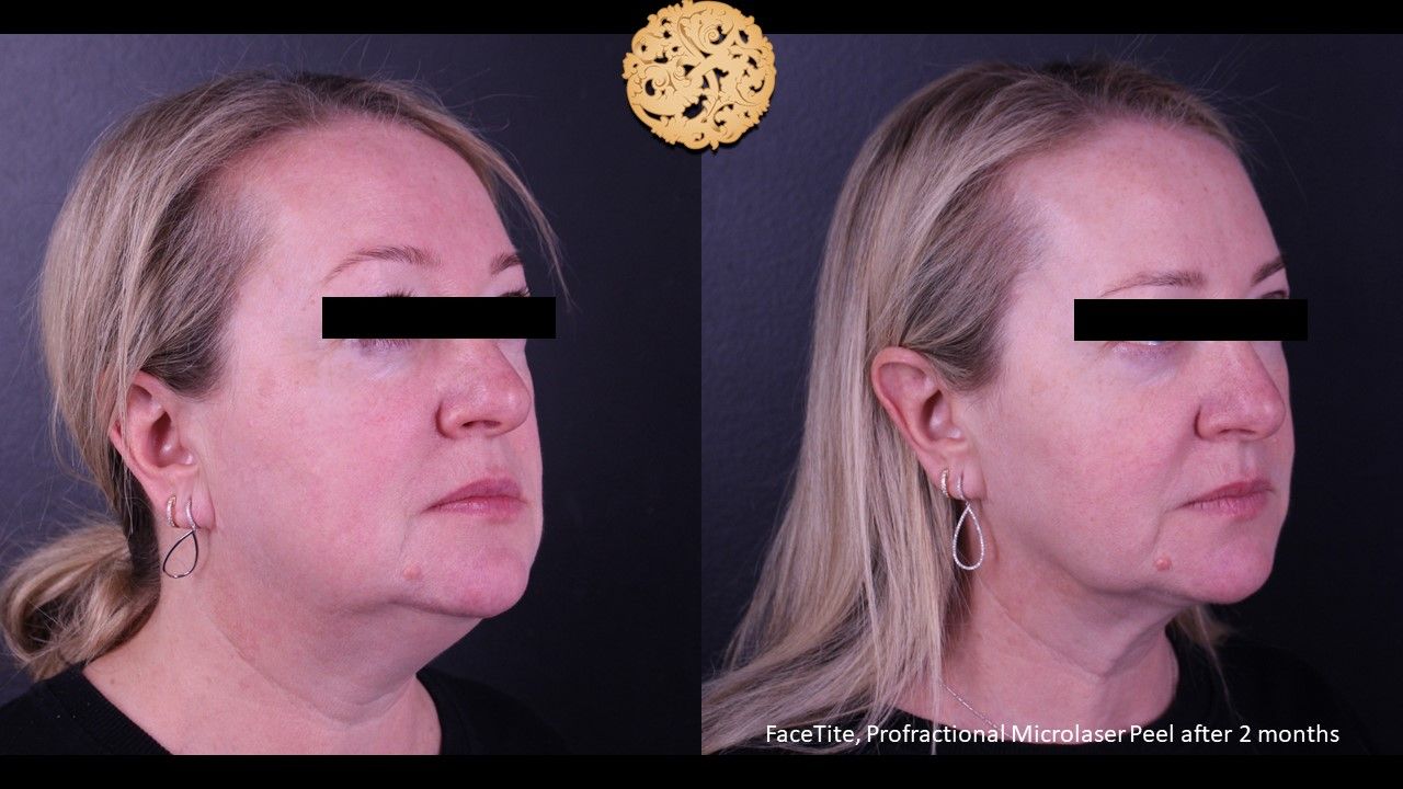 Facetite Before & After