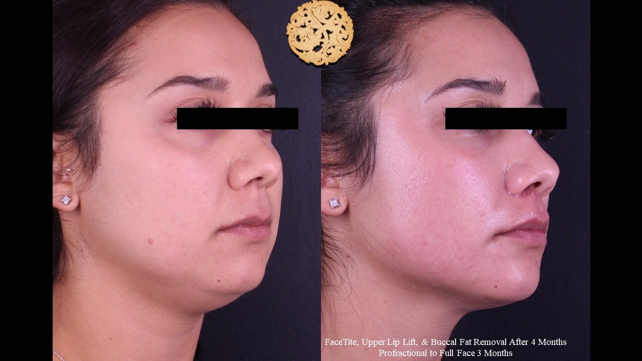 Facetite Before & After