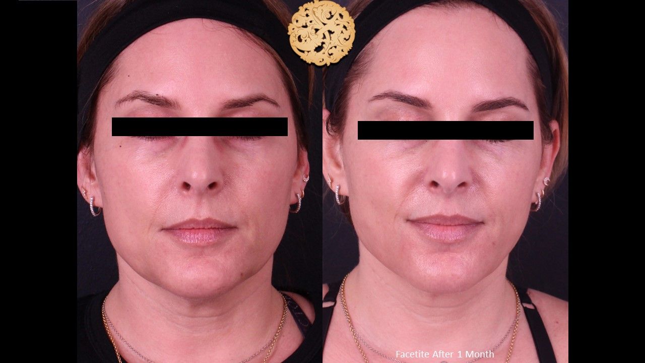 Facetite Before & After