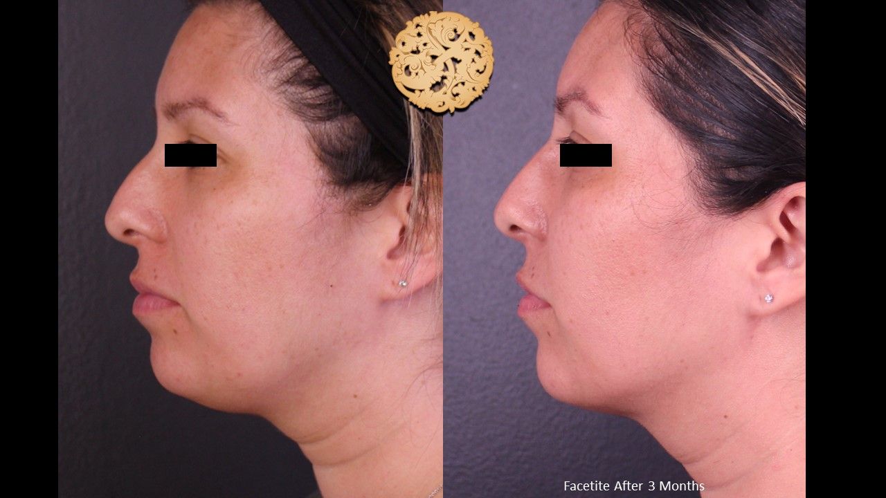 Facetite Before & After