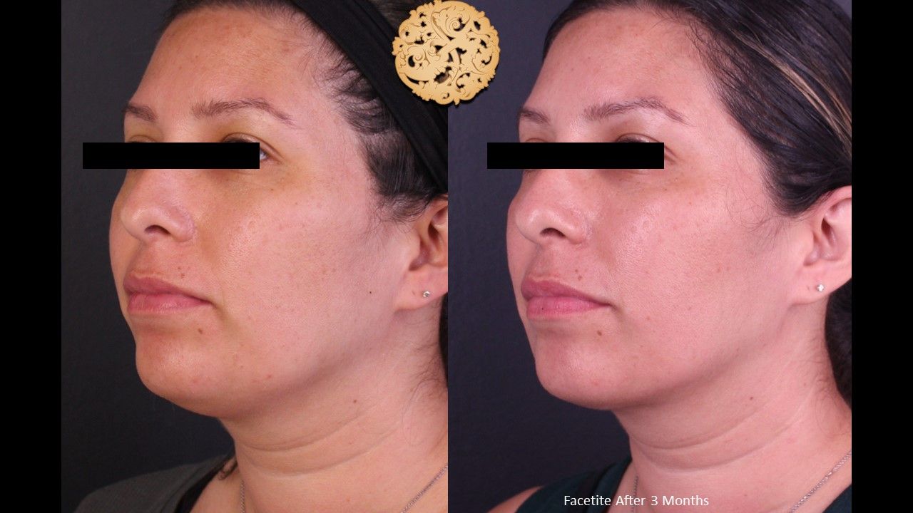 Facetite Before & After