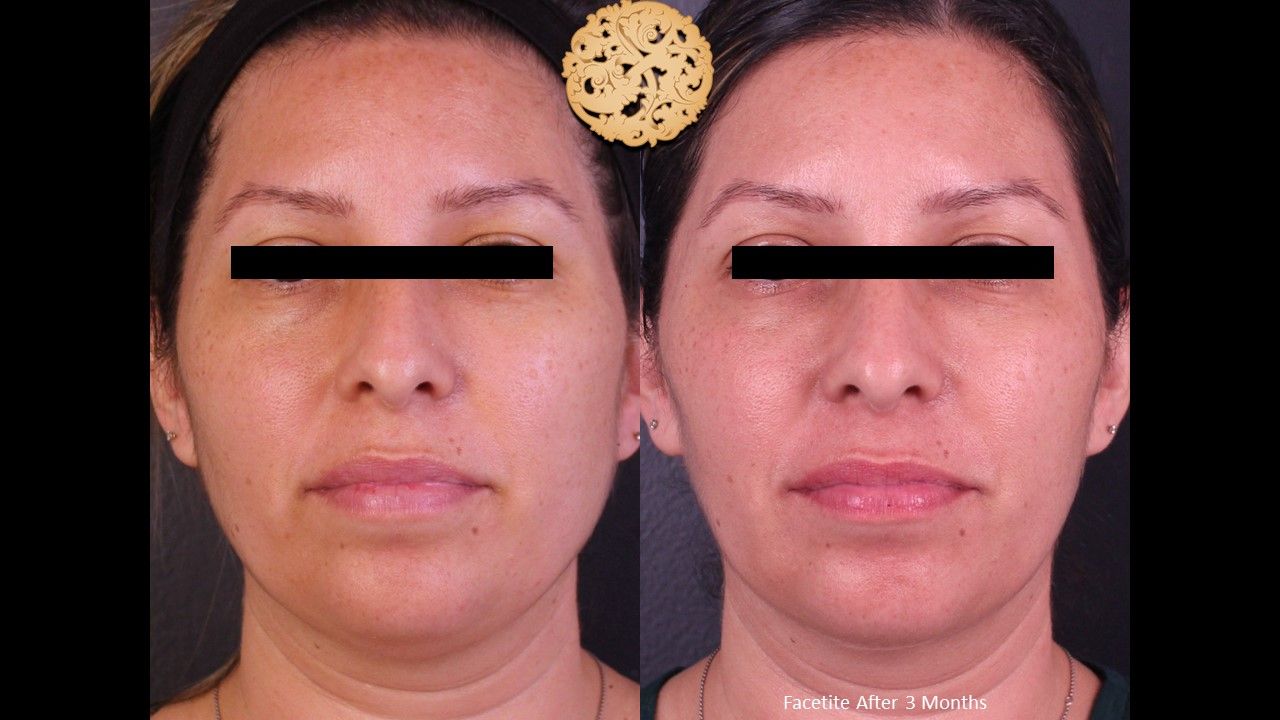 Facetite Before & After