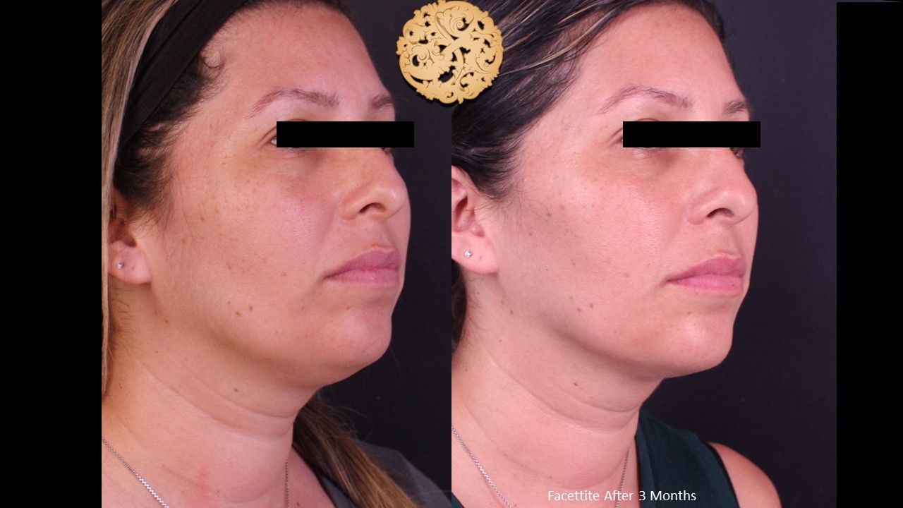 Facetite Before & After