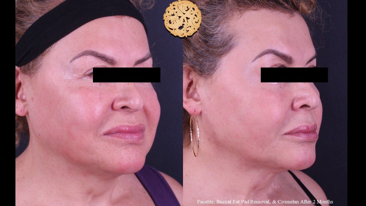 Facetite Before & After