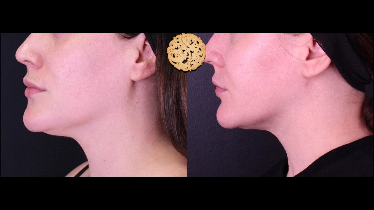 Facetite Before & After