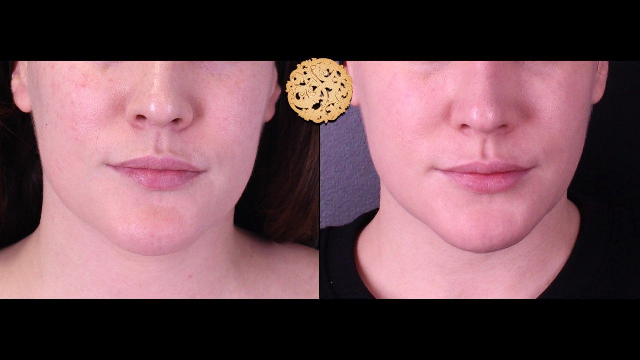 Facetite Before & After