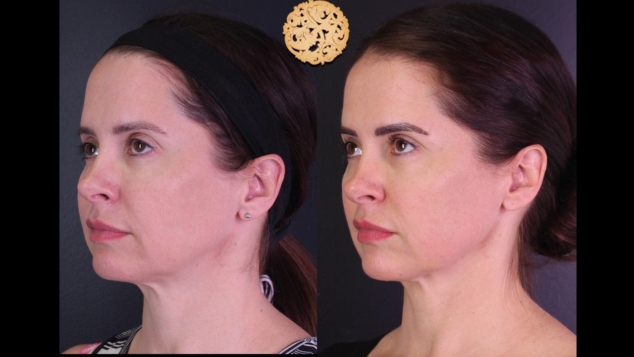 Facetite Before & After