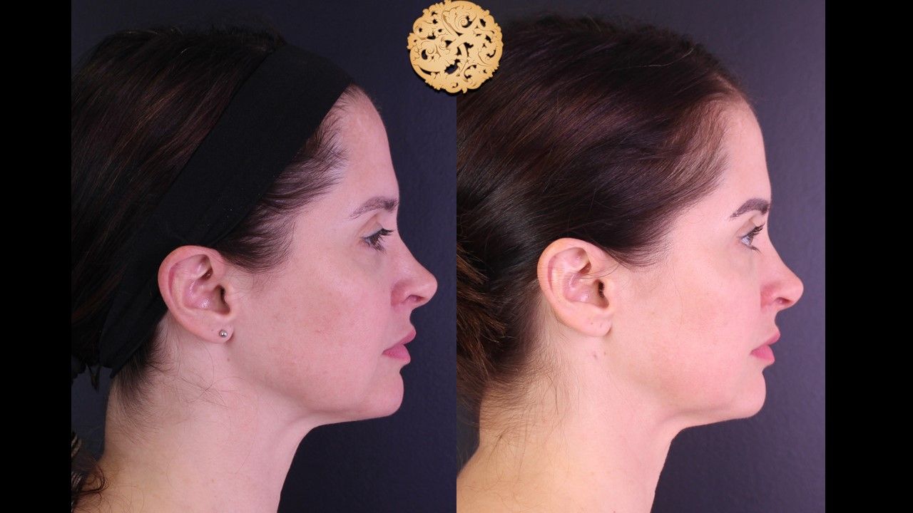 Facetite Before & After