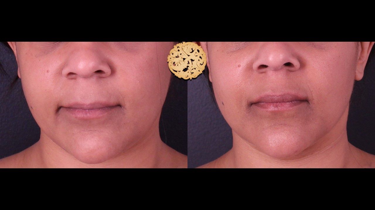 Facetite Before & After