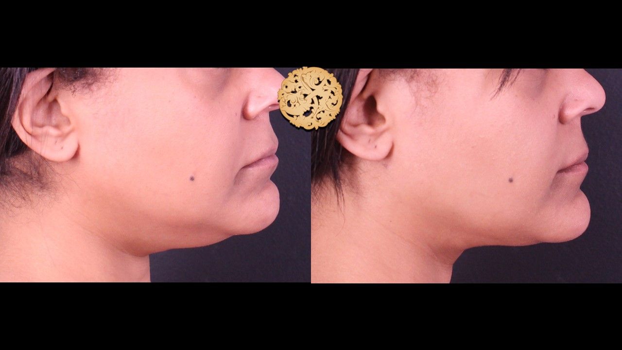 Facetite Before & After