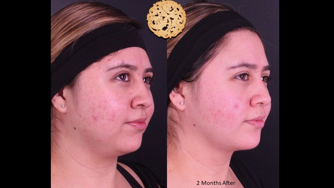 Facetite Before & After