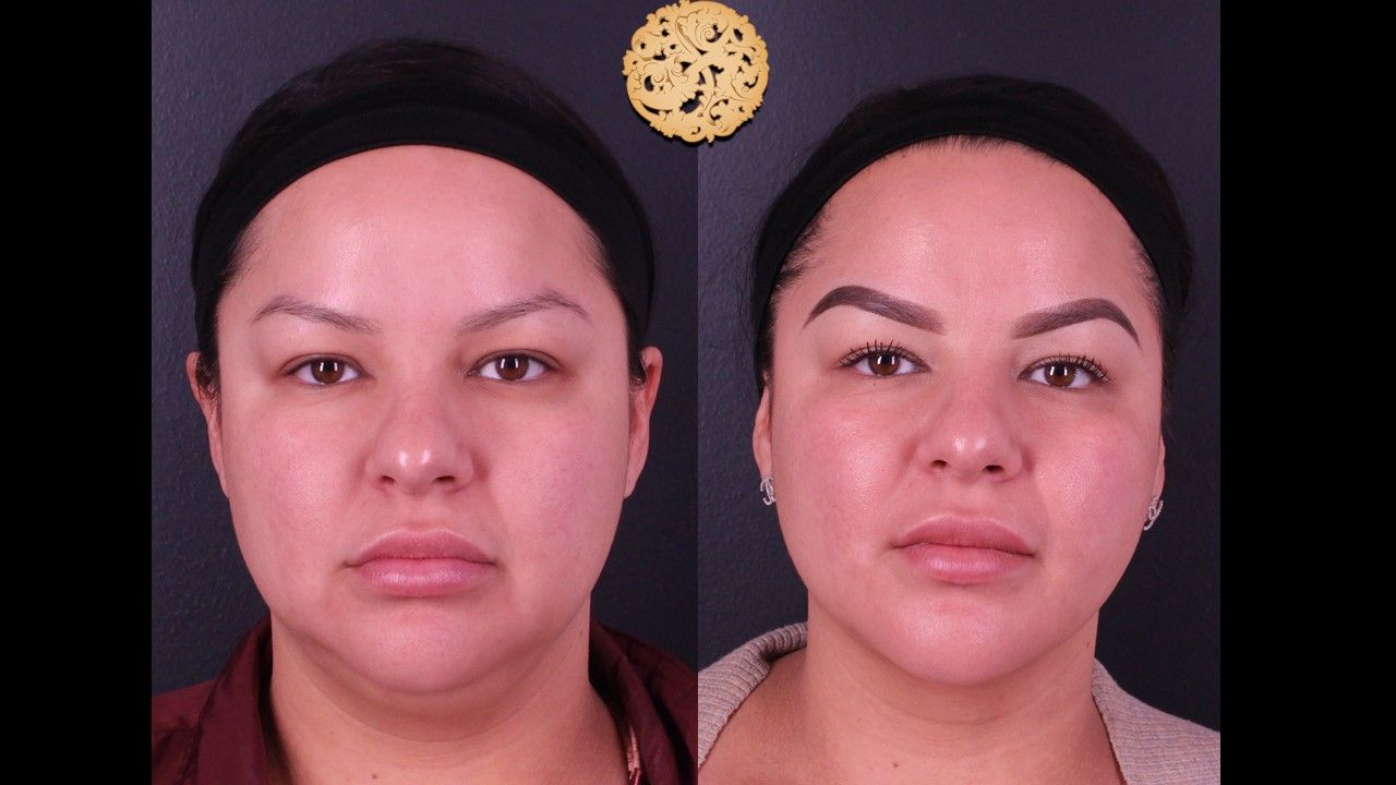Facetite Before & After