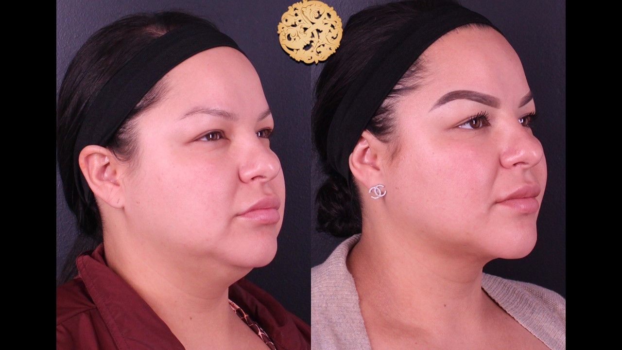 Facetite Before & After
