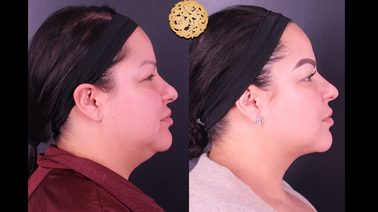 Facetite Before & After