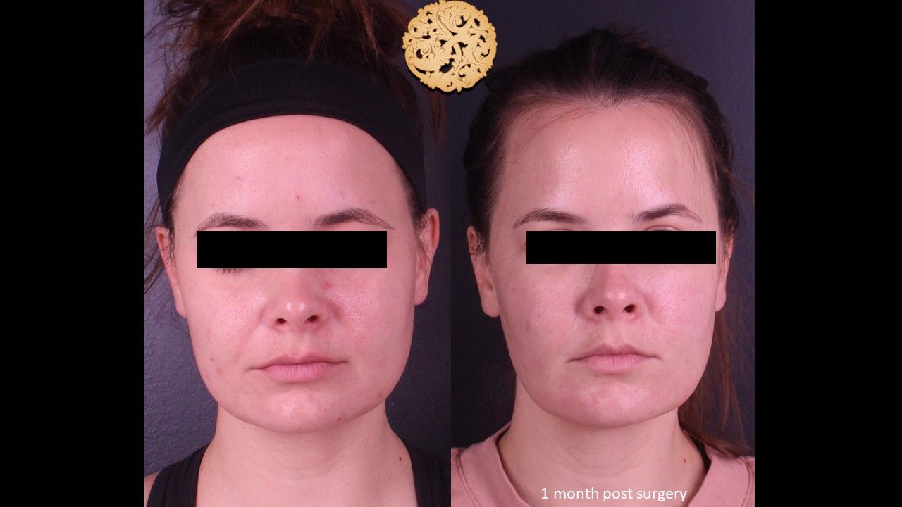 Facetite Before & After