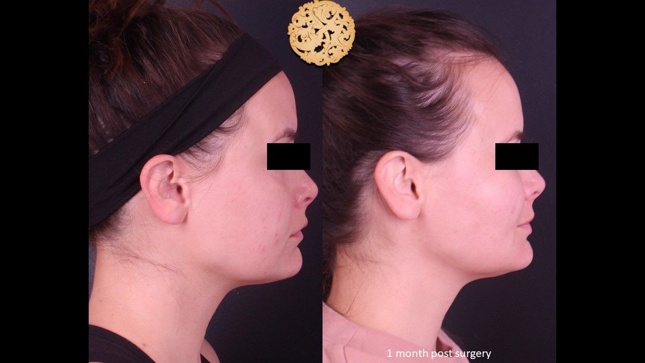 Facetite Before & After