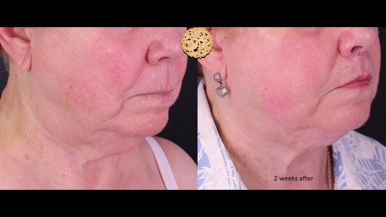 Facetite Before & After