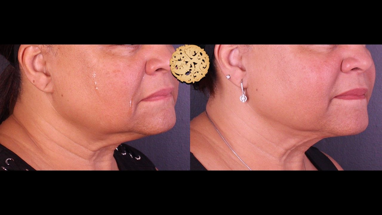 Facetite Before & After