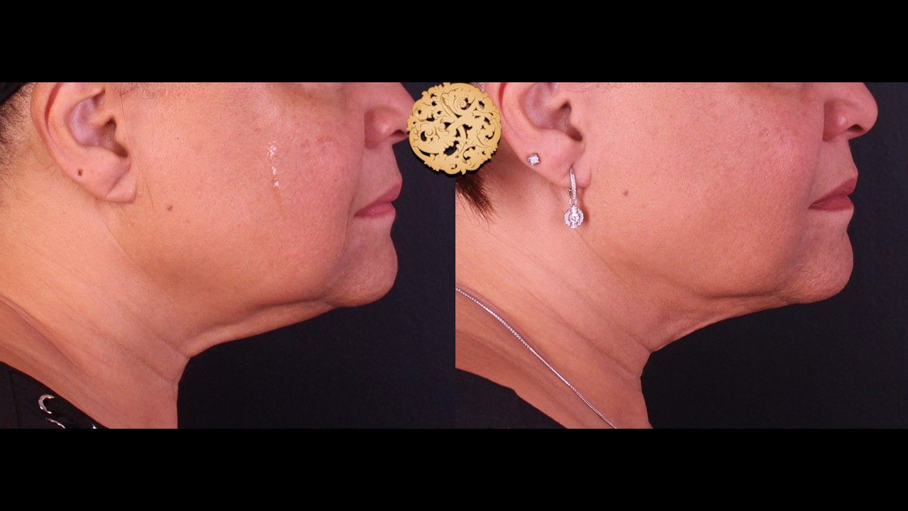 Facetite Before & After